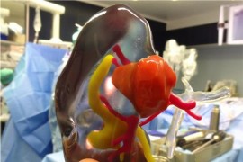 法国医院将3D打印彩色模型用于肾肿瘤切除手术（图文教程）