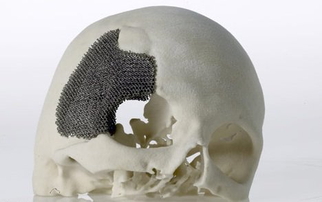 金属3D打印在骨科植入物领域的应用（图文教程）,金属3D打印在骨科植入物领域的应用,图文,第3张